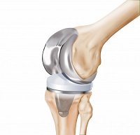 HQ_ILL_Complete_Knee_Components.jpg_ico500